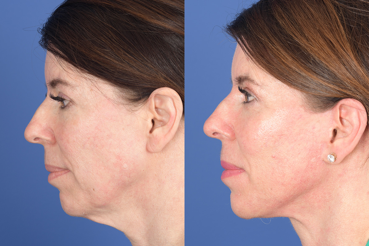 Facelift Before and After | Weber Facial Plastic Surgery