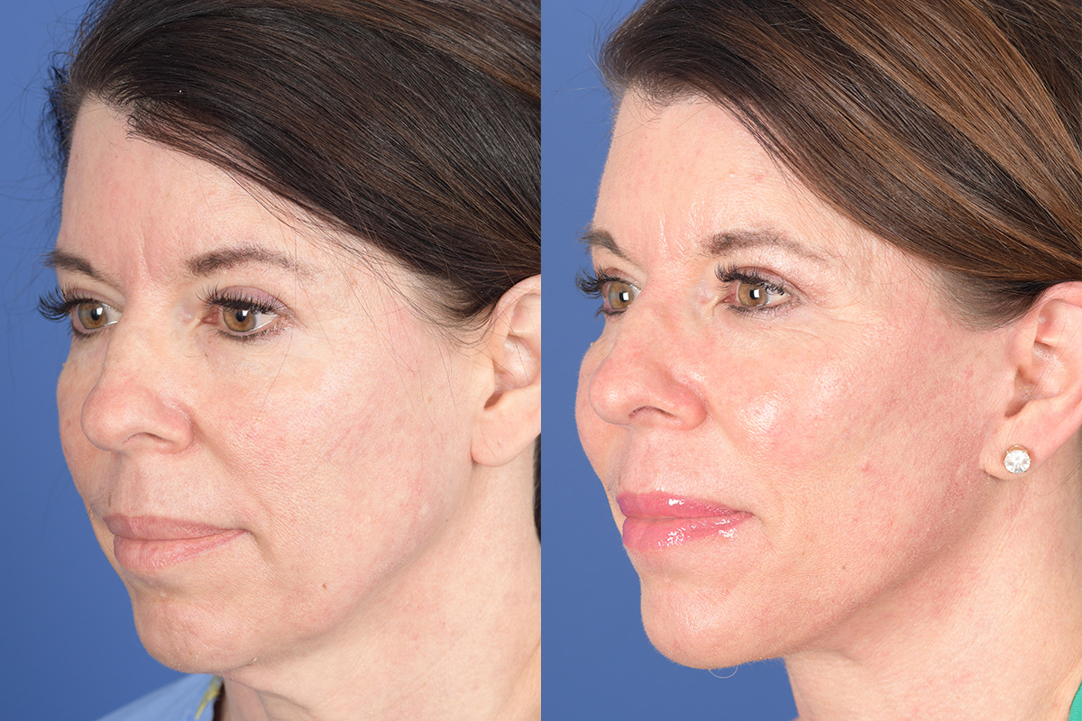 Facelift Before and After | Weber Facial Plastic Surgery