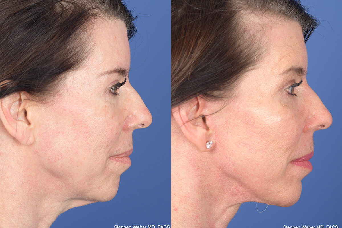 Facelift Before and After | Weber Facial Plastic Surgery