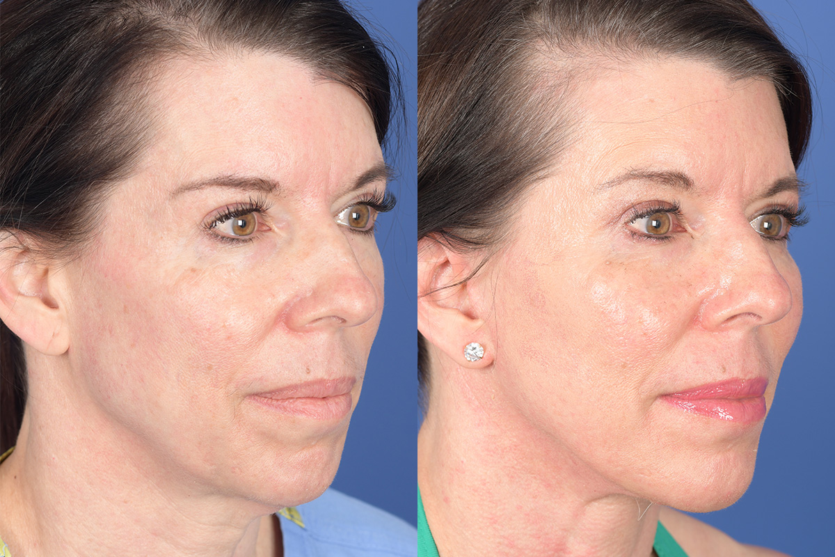 Facelift Before and After | Weber Facial Plastic Surgery