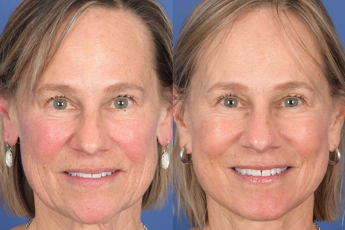 Facelift Before and After | Weber Facial Plastic Surgery