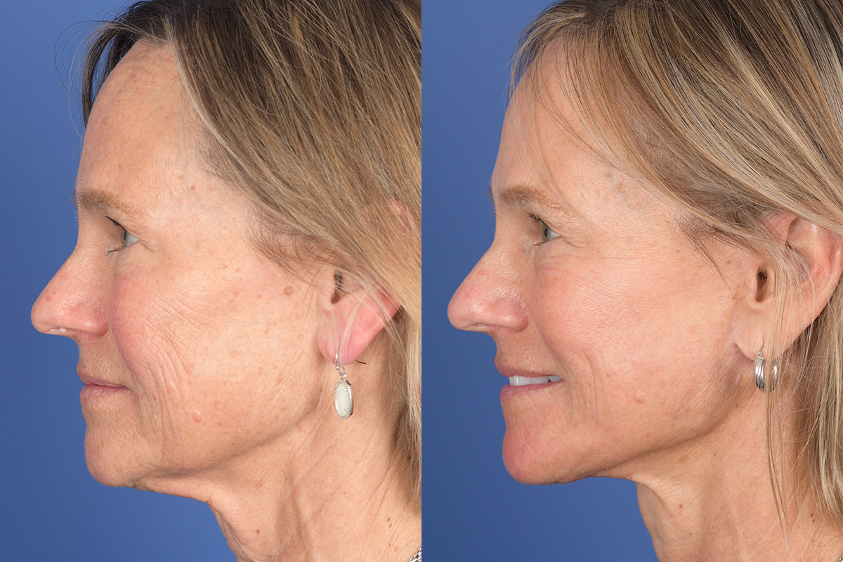 Facelift Before and After | Weber Facial Plastic Surgery