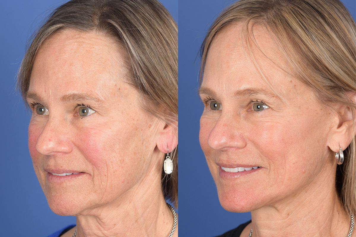 Facelift Before and After | Weber Facial Plastic Surgery
