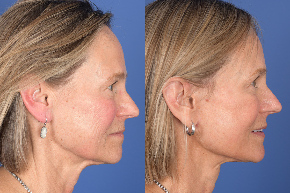 Facelift Before and After | Weber Facial Plastic Surgery