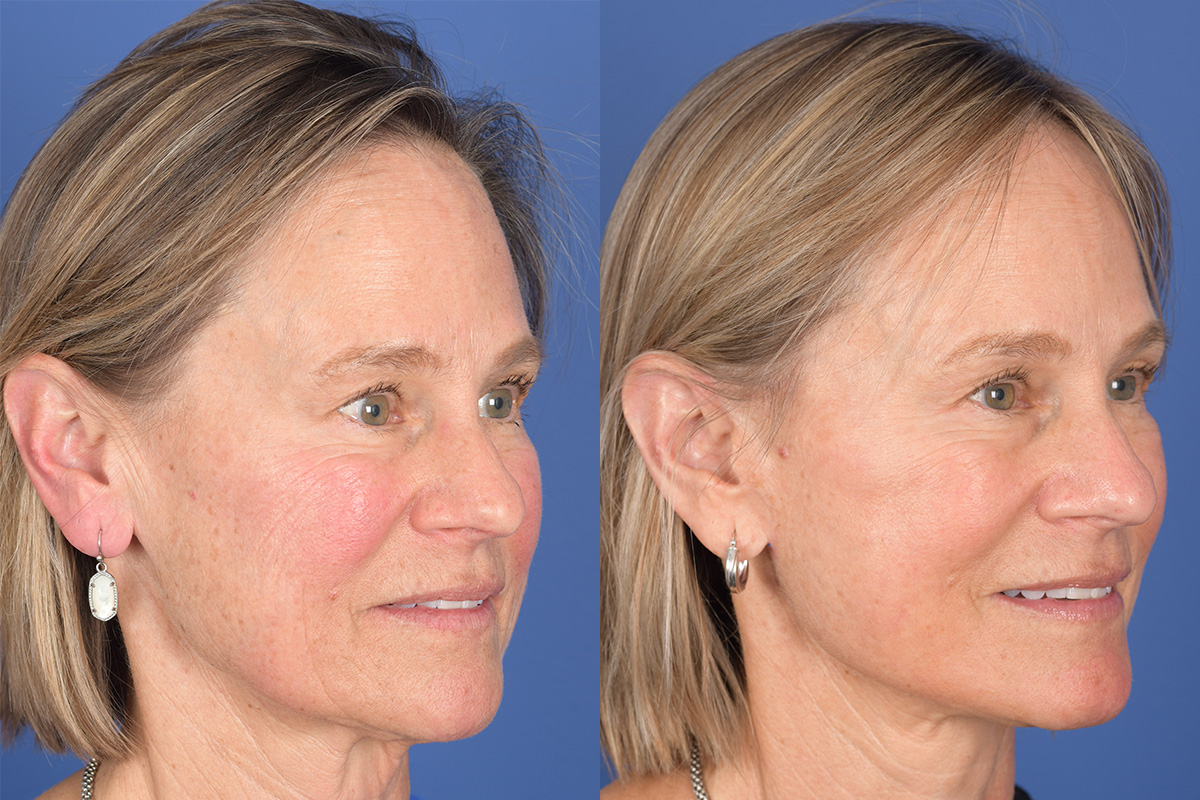 Facelift Before and After | Weber Facial Plastic Surgery