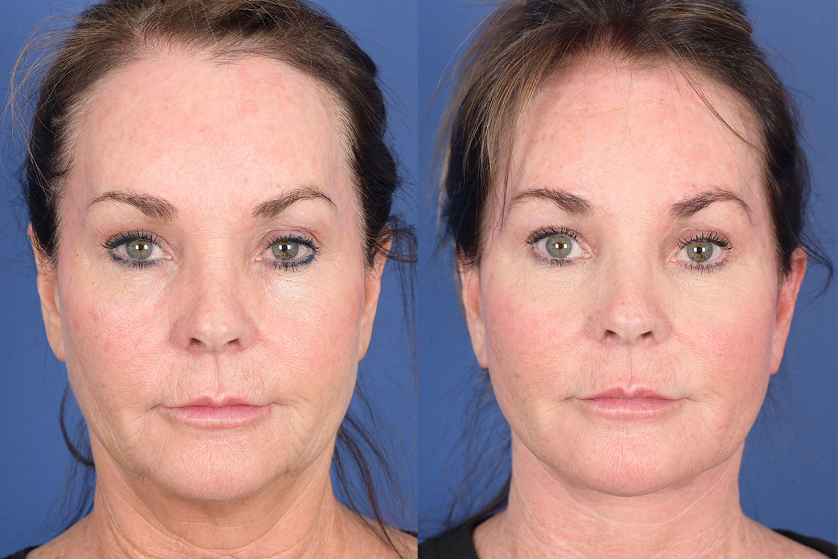 Facelift Before and After | Weber Facial Plastic Surgery