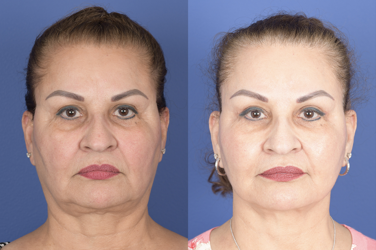 Facelift Before and After | Weber Facial Plastic Surgery