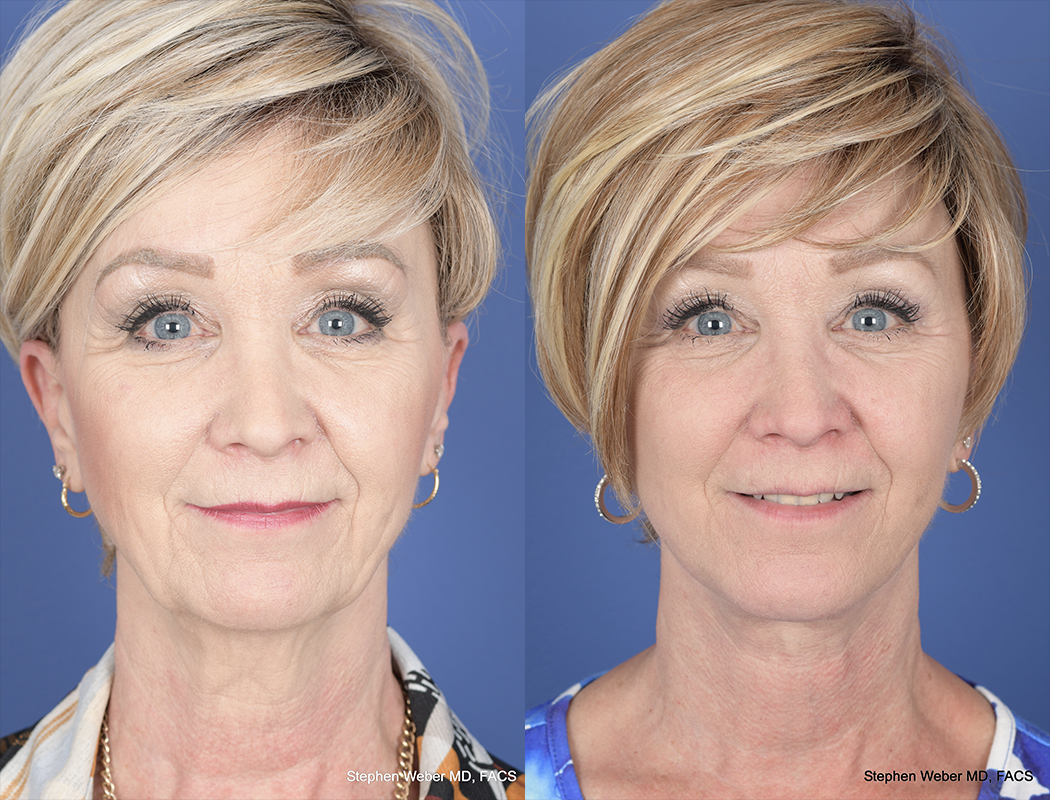 Facelift Before and After | Weber Facial Plastic Surgery
