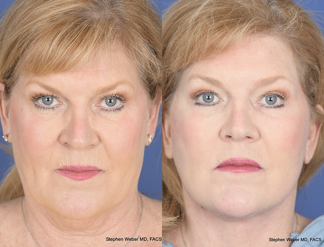 Facelift Before and After | Weber Facial Plastic Surgery