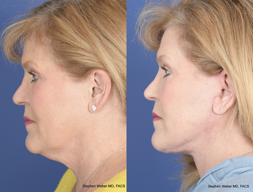 Facelift Before and After | Weber Facial Plastic Surgery