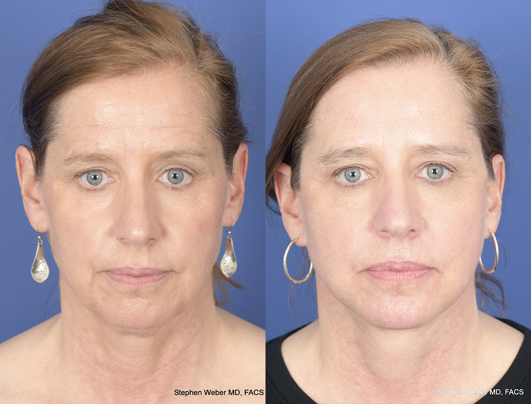 Facelift Before and After | Weber Facial Plastic Surgery