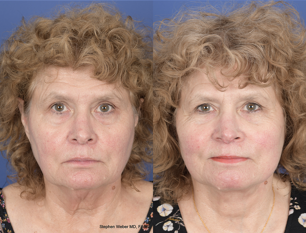 Facelift Before and After | Weber Facial Plastic Surgery
