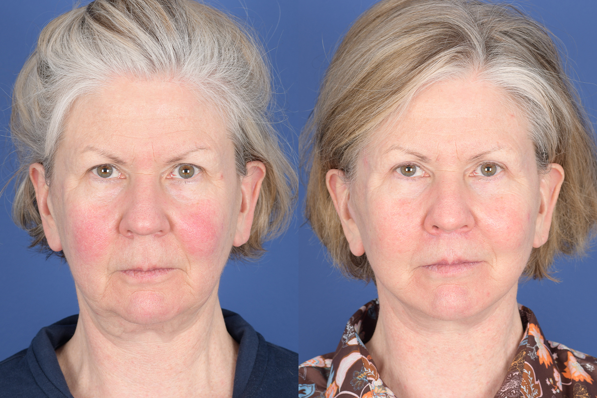 Facelift Before and After | Weber Facial Plastic Surgery