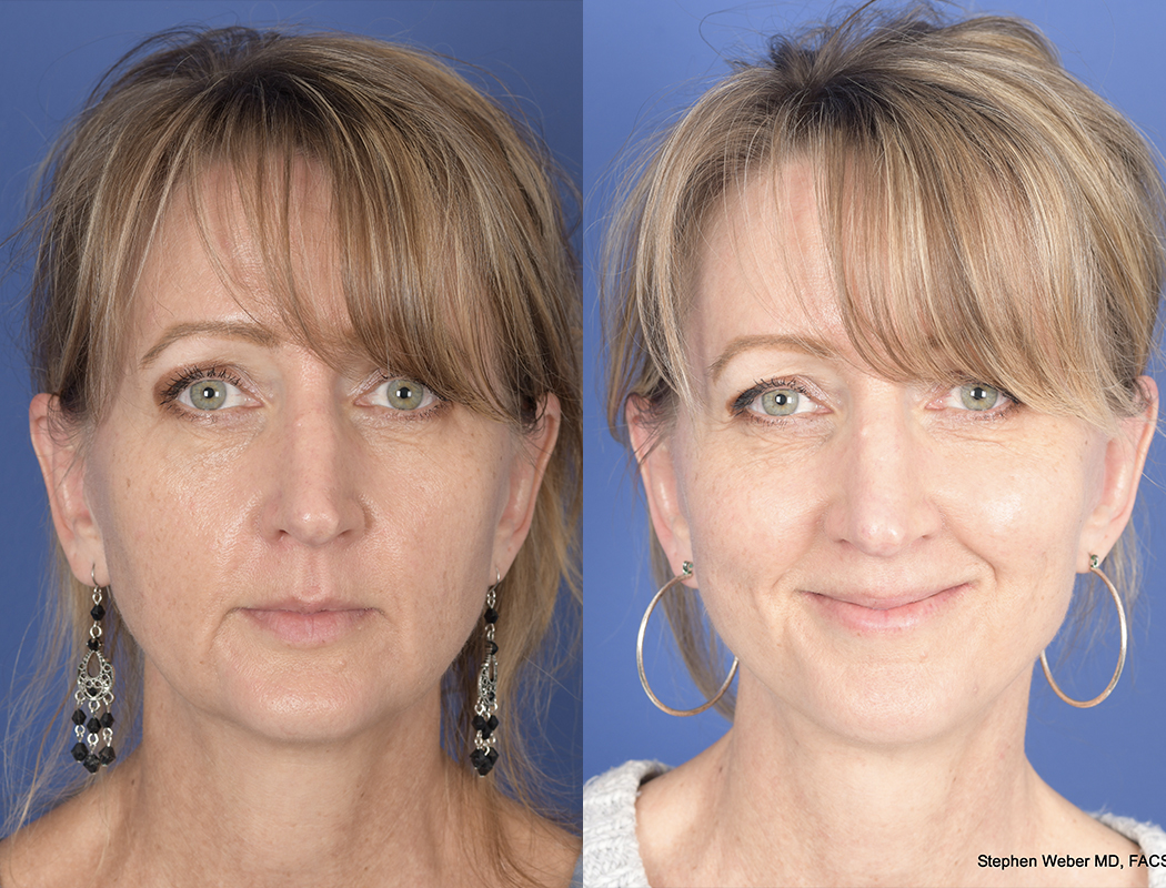 Facelift Before and After | Weber Facial Plastic Surgery