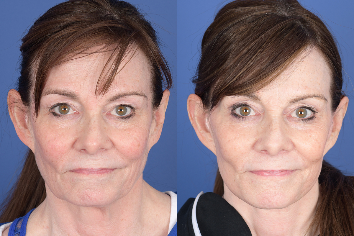 Facelift Before and After | Weber Facial Plastic Surgery