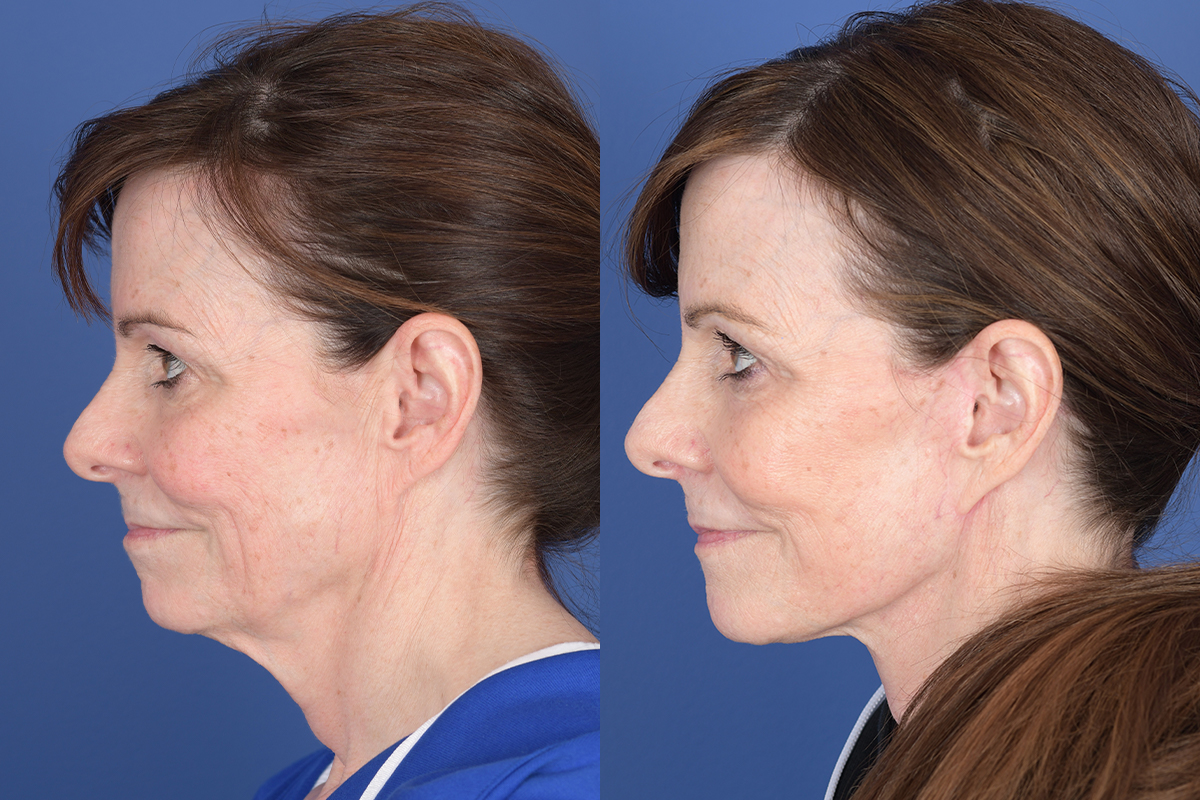 Facelift Before and After | Weber Facial Plastic Surgery