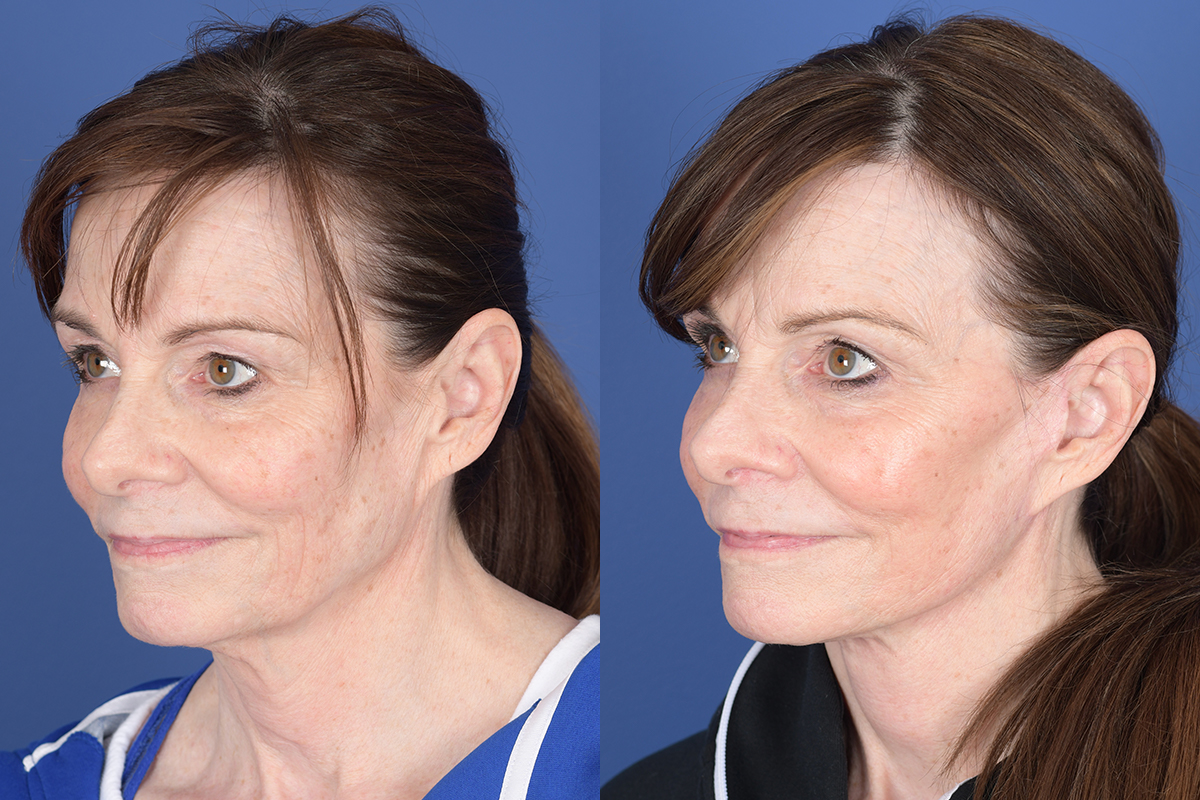 Facelift Before and After | Weber Facial Plastic Surgery
