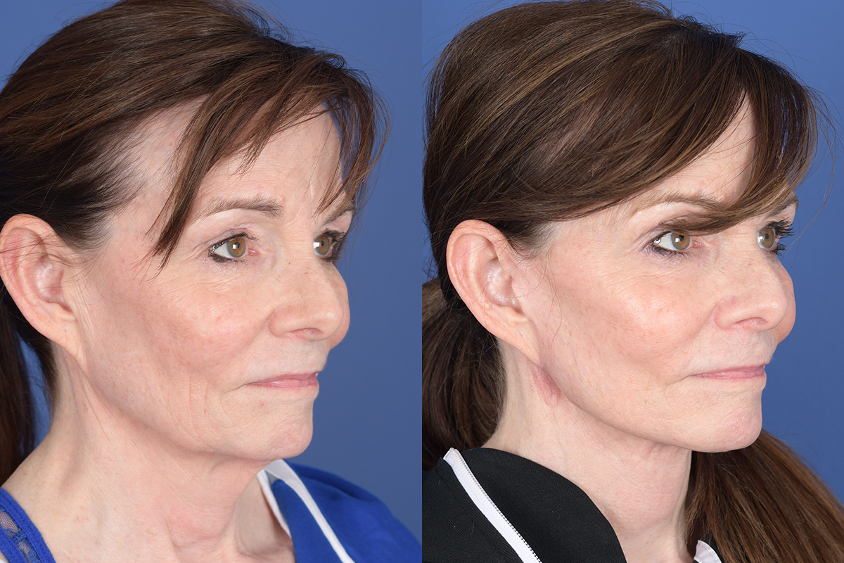 Facelift Before and After | Weber Facial Plastic Surgery