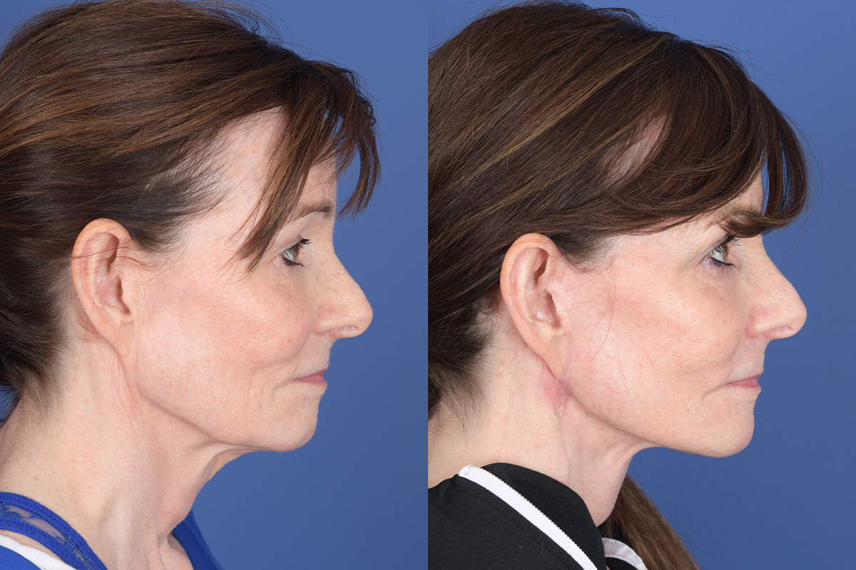Facelift Before and After | Weber Facial Plastic Surgery