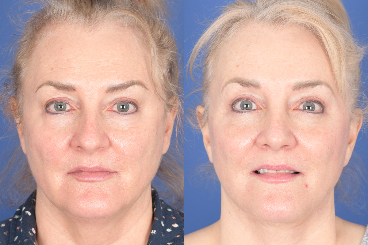 Facelift Before and After | Weber Facial Plastic Surgery