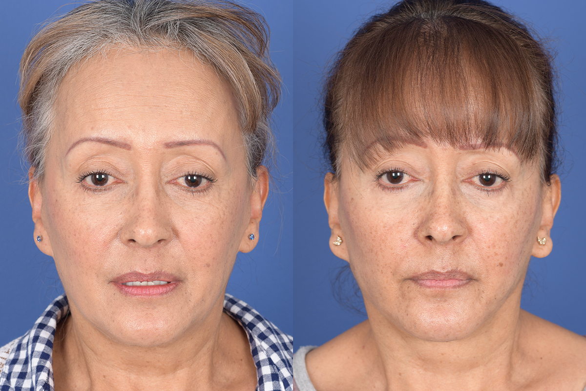 Facelift Before and After | Weber Facial Plastic Surgery