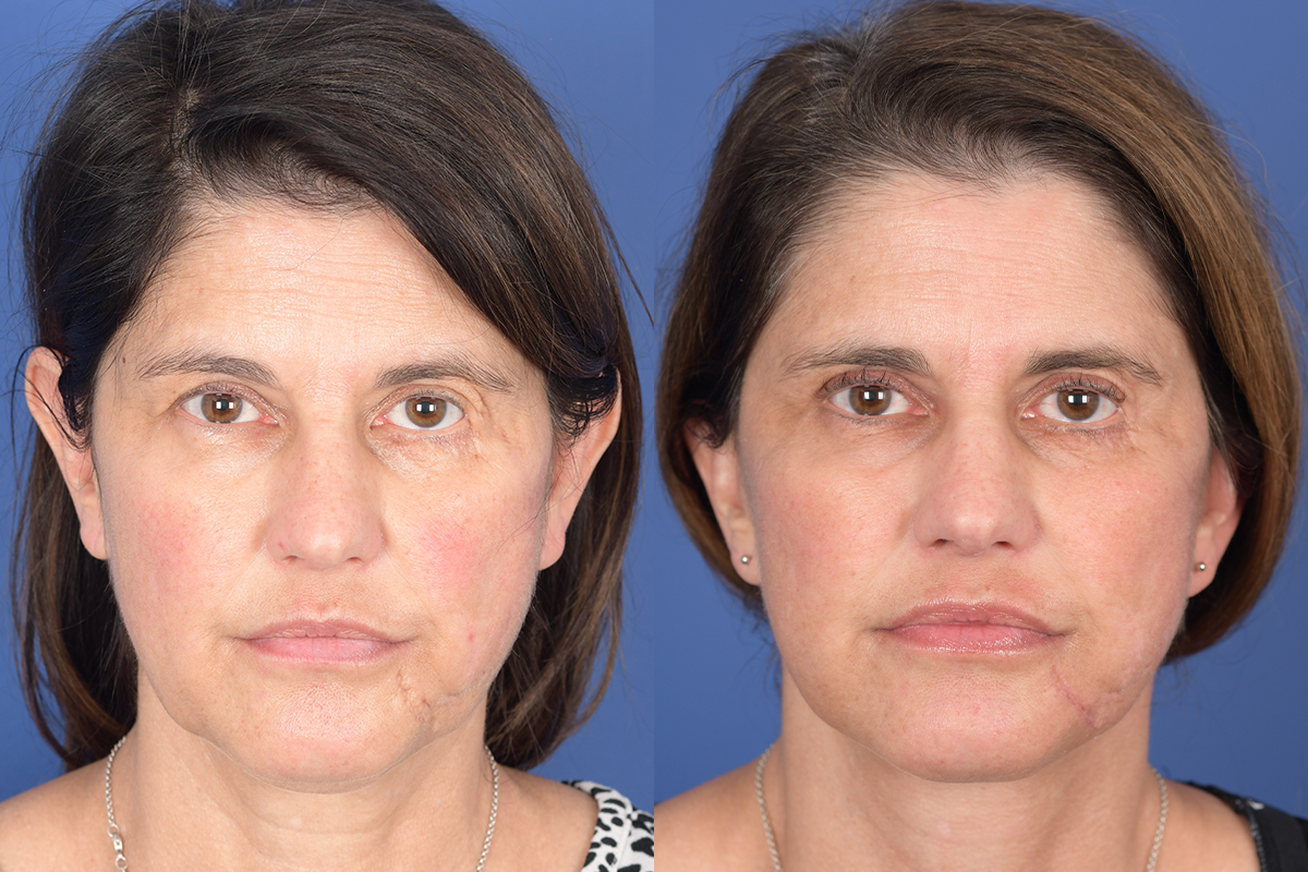 Facelift Before and After | Weber Facial Plastic Surgery