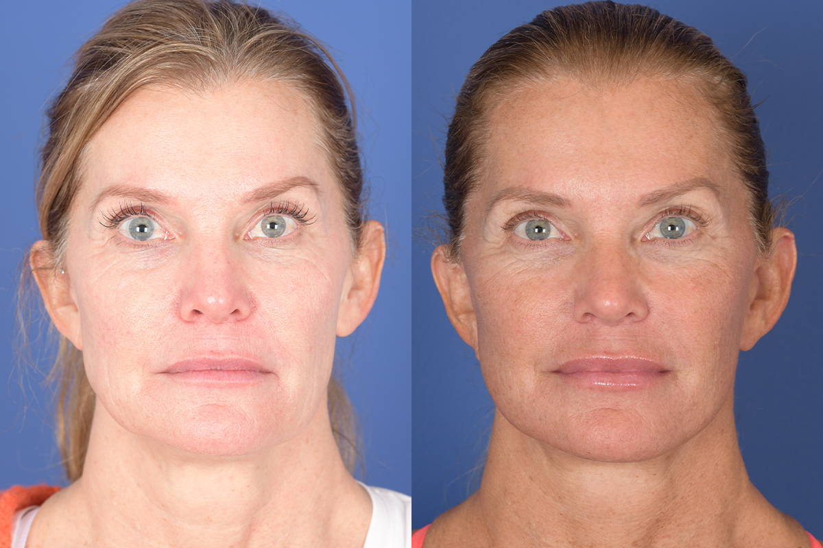 Facelift Before and After | Weber Facial Plastic Surgery