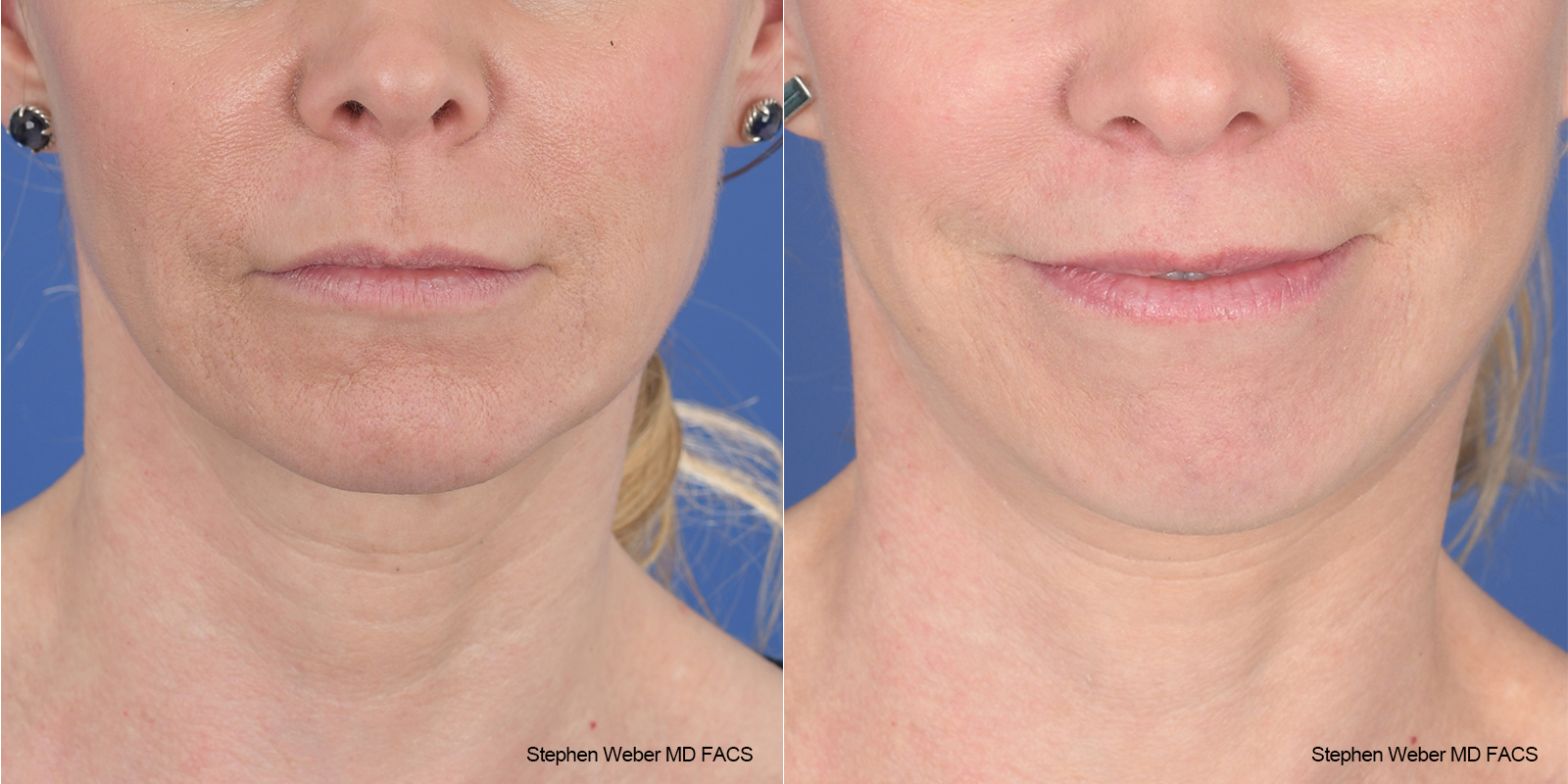 Facelift Before and After | Weber Facial Plastic Surgery