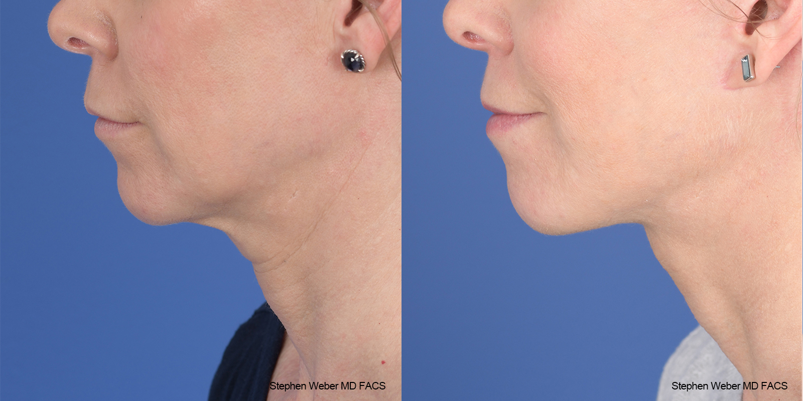 Facelift Before and After | Weber Facial Plastic Surgery