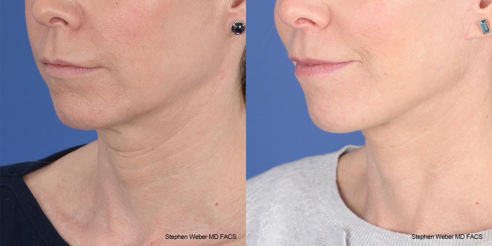 Facelift Before and After | Weber Facial Plastic Surgery