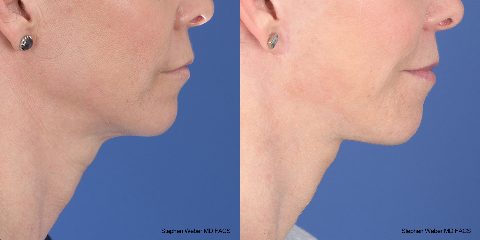 Facelift Before and After | Weber Facial Plastic Surgery