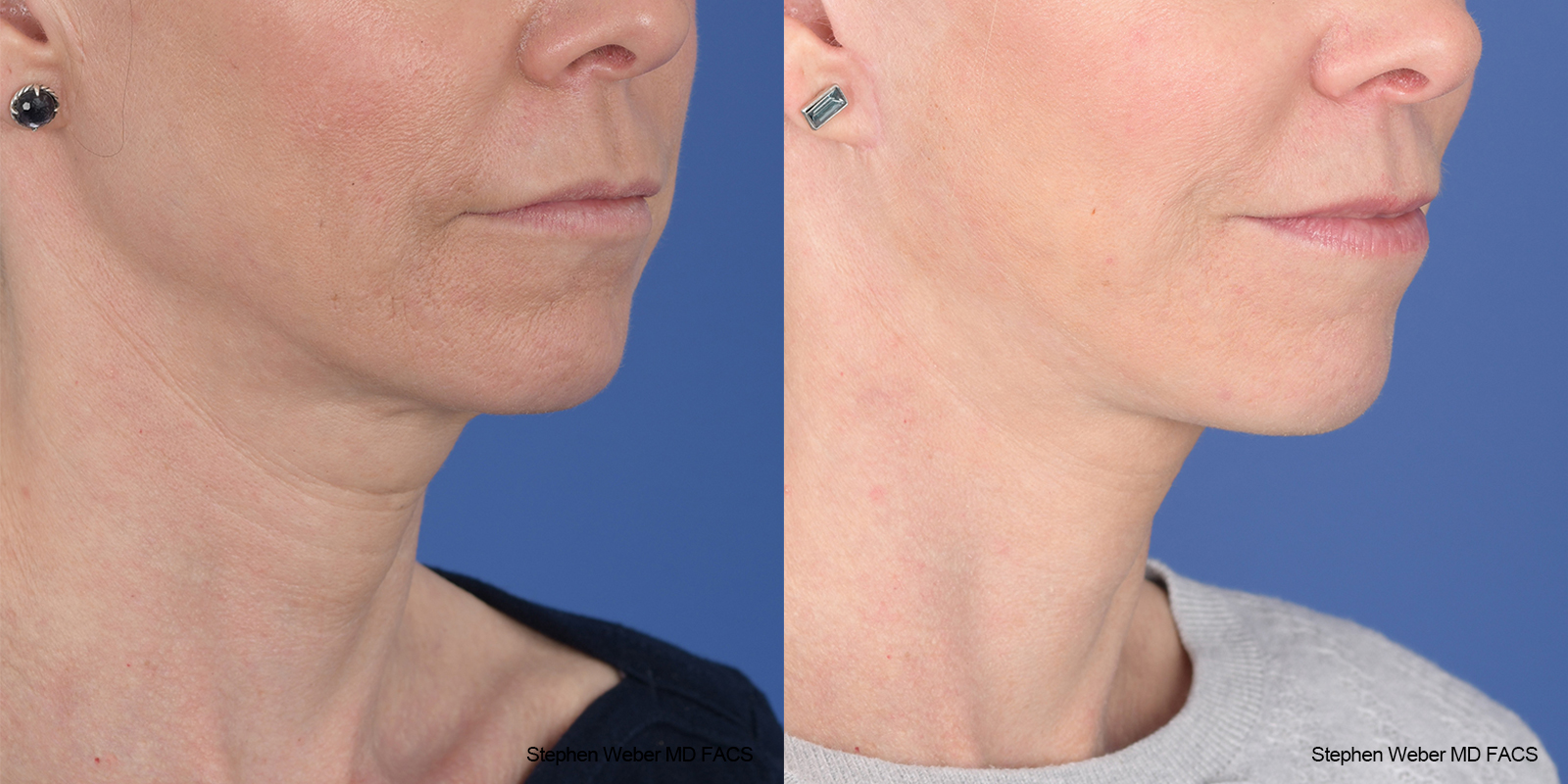 Facelift Before and After | Weber Facial Plastic Surgery