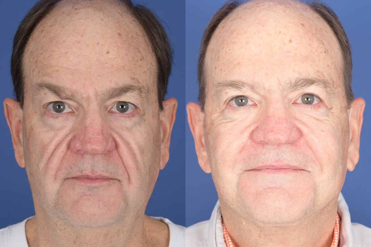 Facelift Before and After | Weber Facial Plastic Surgery