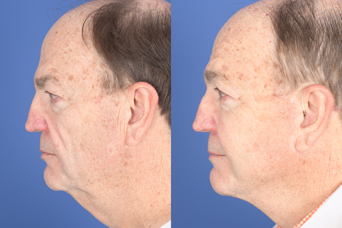 Facelift Before and After | Weber Facial Plastic Surgery