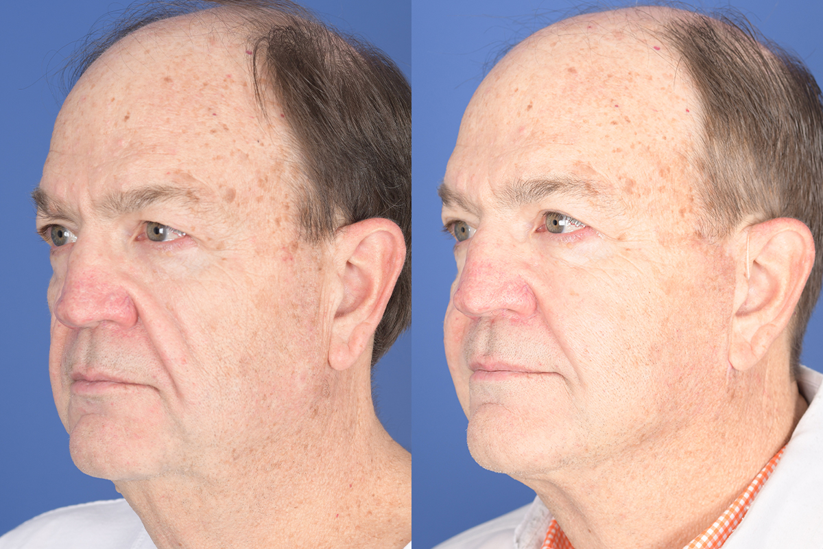 Facelift Before and After | Weber Facial Plastic Surgery