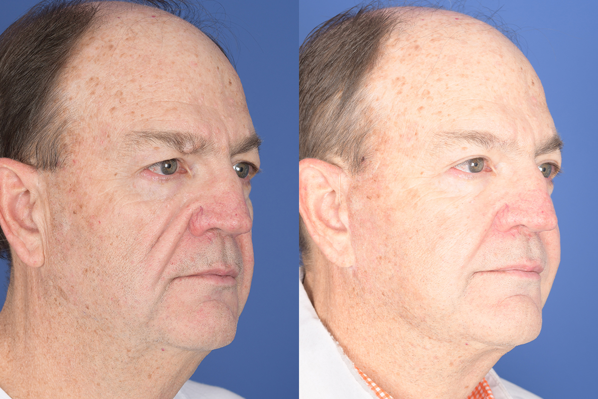Facelift Before and After | Weber Facial Plastic Surgery