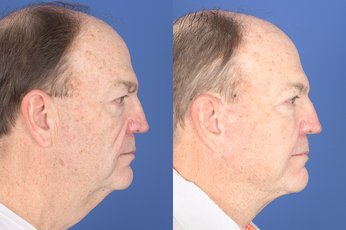 Facelift Before and After | Weber Facial Plastic Surgery