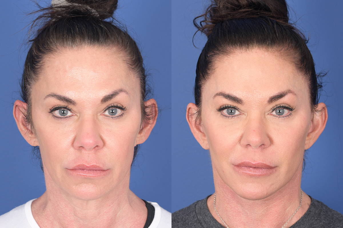 Facelift Before and After | Weber Facial Plastic Surgery