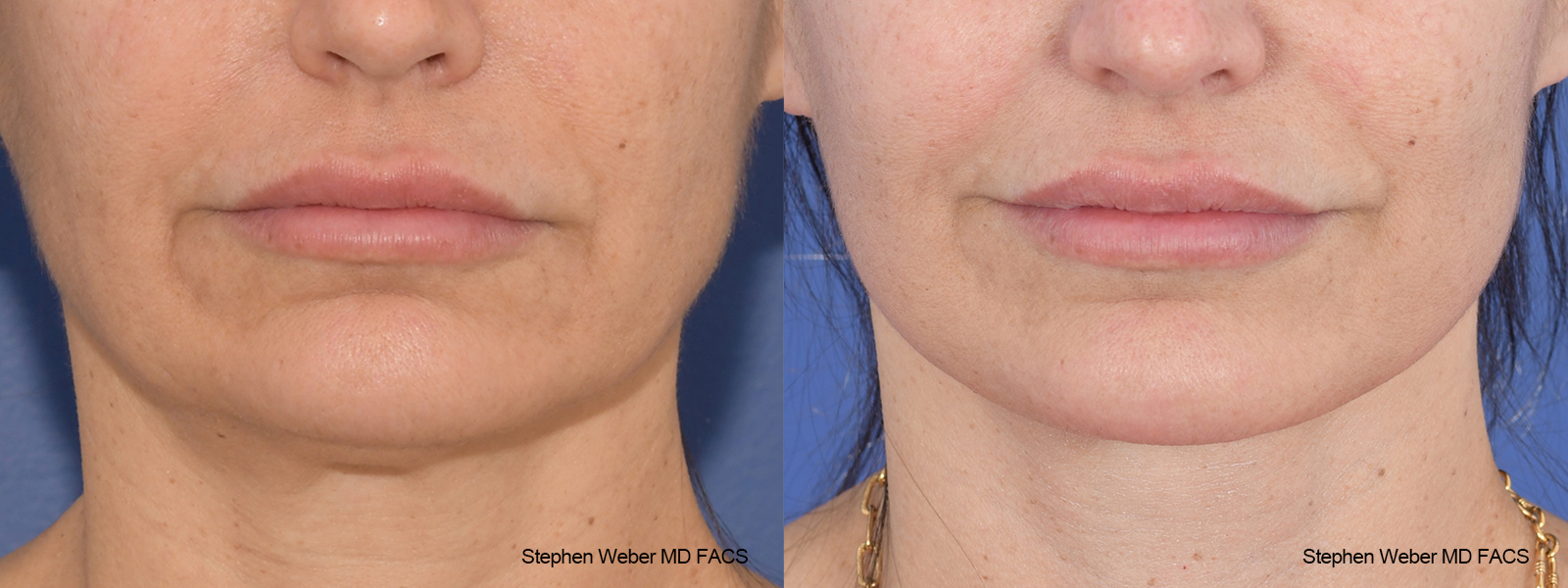 Facelift Before and After | Weber Facial Plastic Surgery