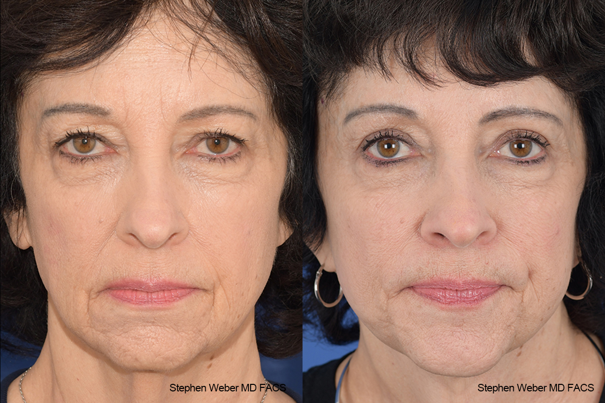 Facelift Before and After | Weber Facial Plastic Surgery