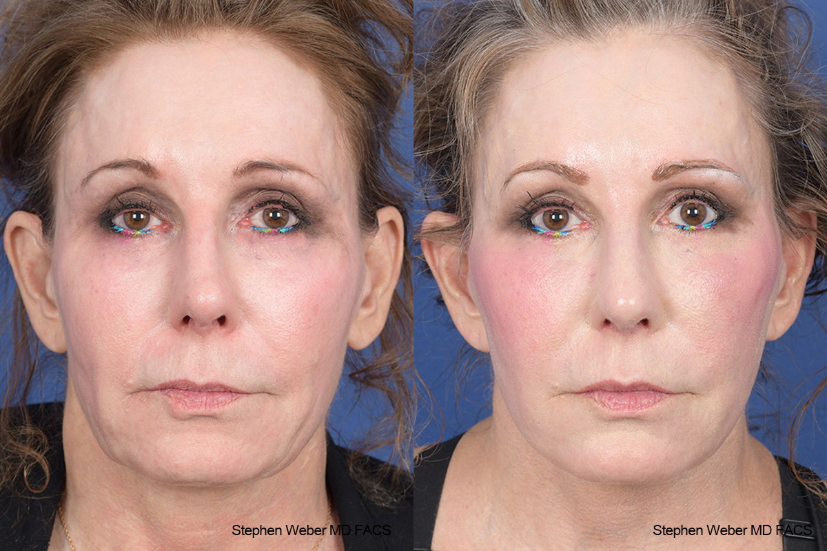 Facelift Before and After | Weber Facial Plastic Surgery