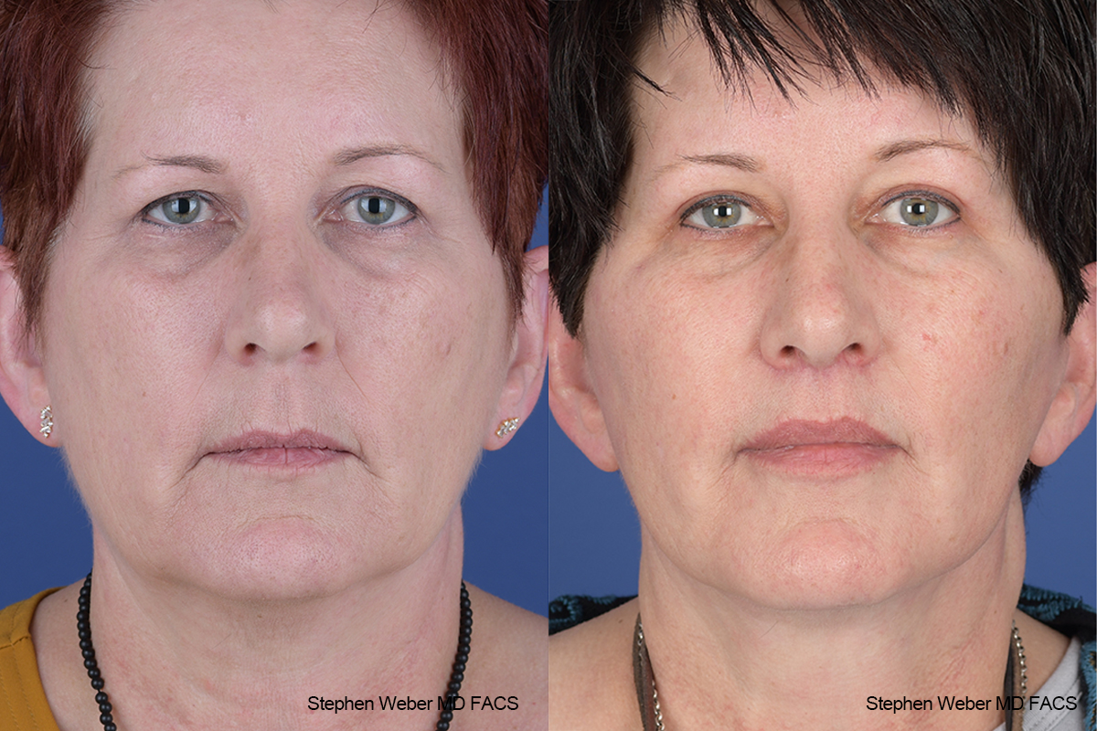 Facelift Before and After | Weber Facial Plastic Surgery