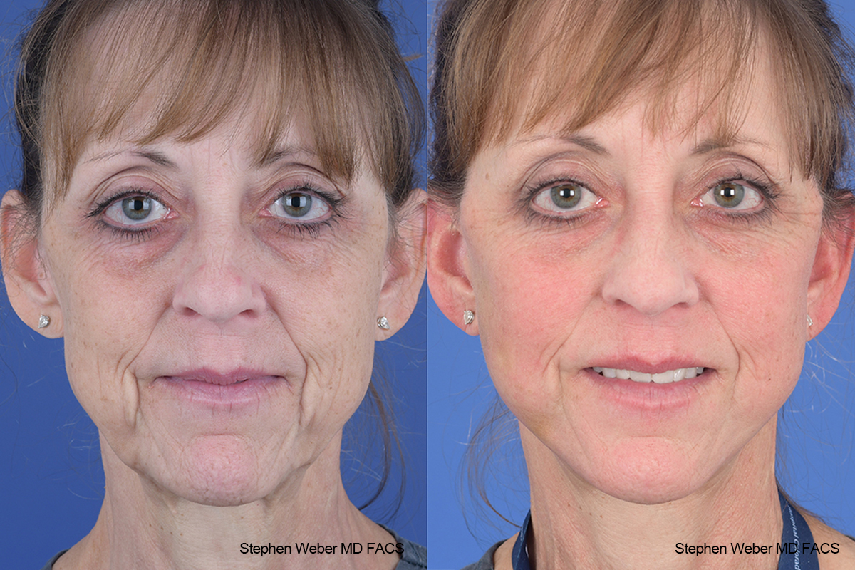 Facelift Before and After | Weber Facial Plastic Surgery