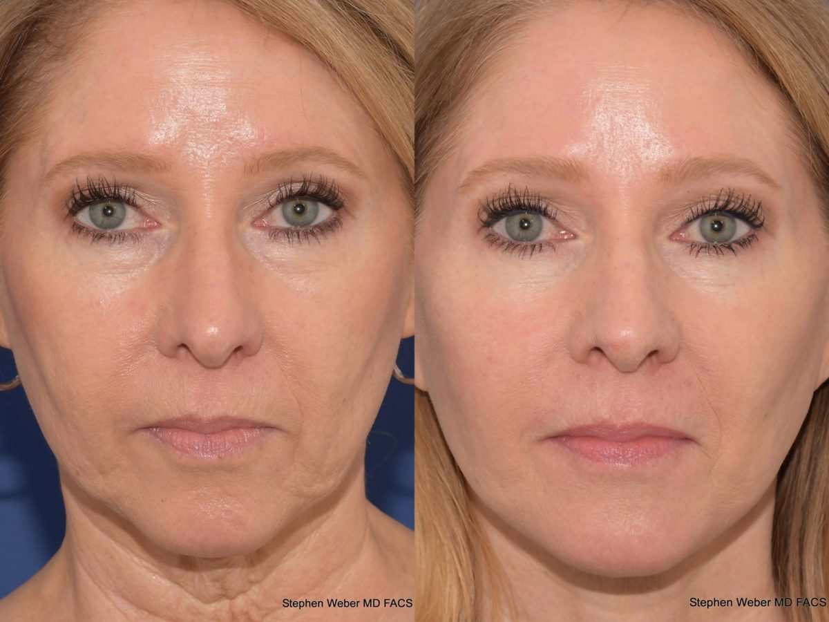 Facelift Before and After | Weber Facial Plastic Surgery