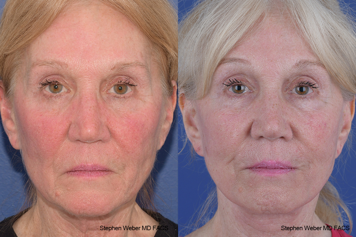 Facelift Before and After | Weber Facial Plastic Surgery