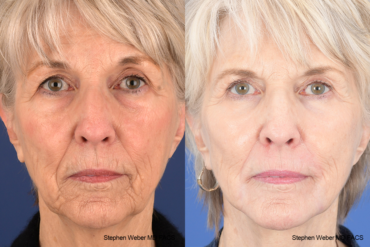 Facelift Before and After | Weber Facial Plastic Surgery