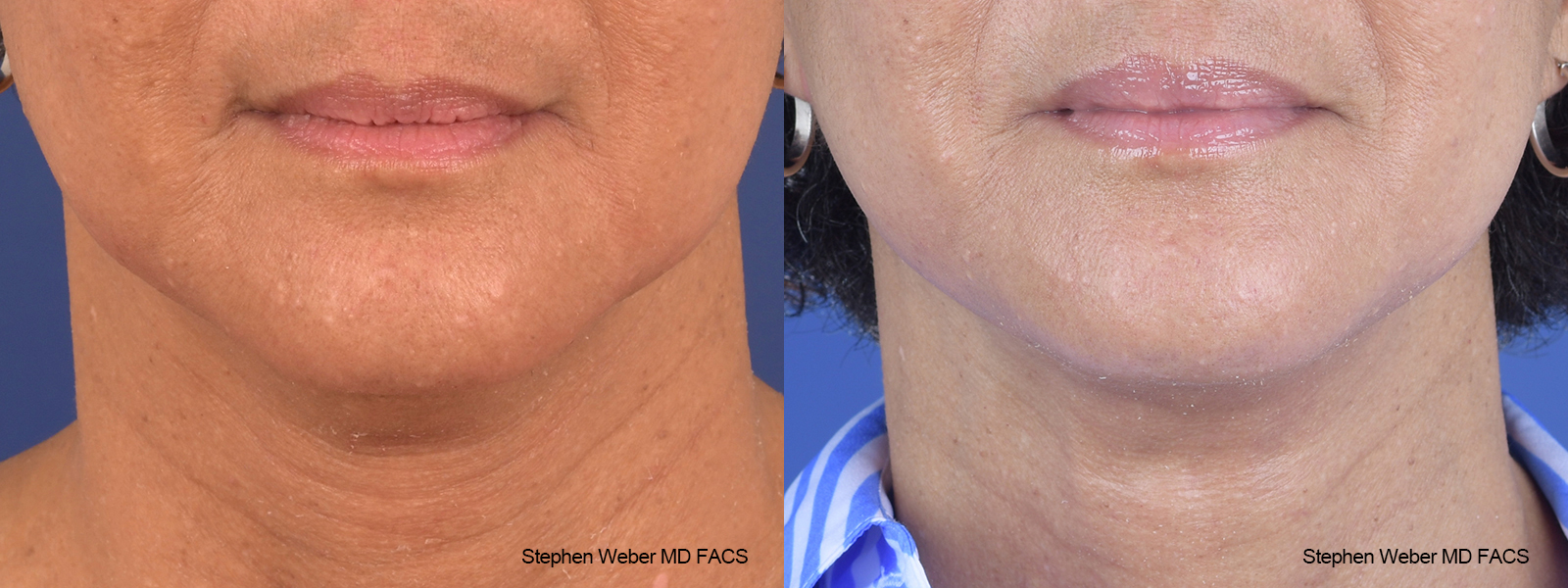 Facelift Before and After | Weber Facial Plastic Surgery