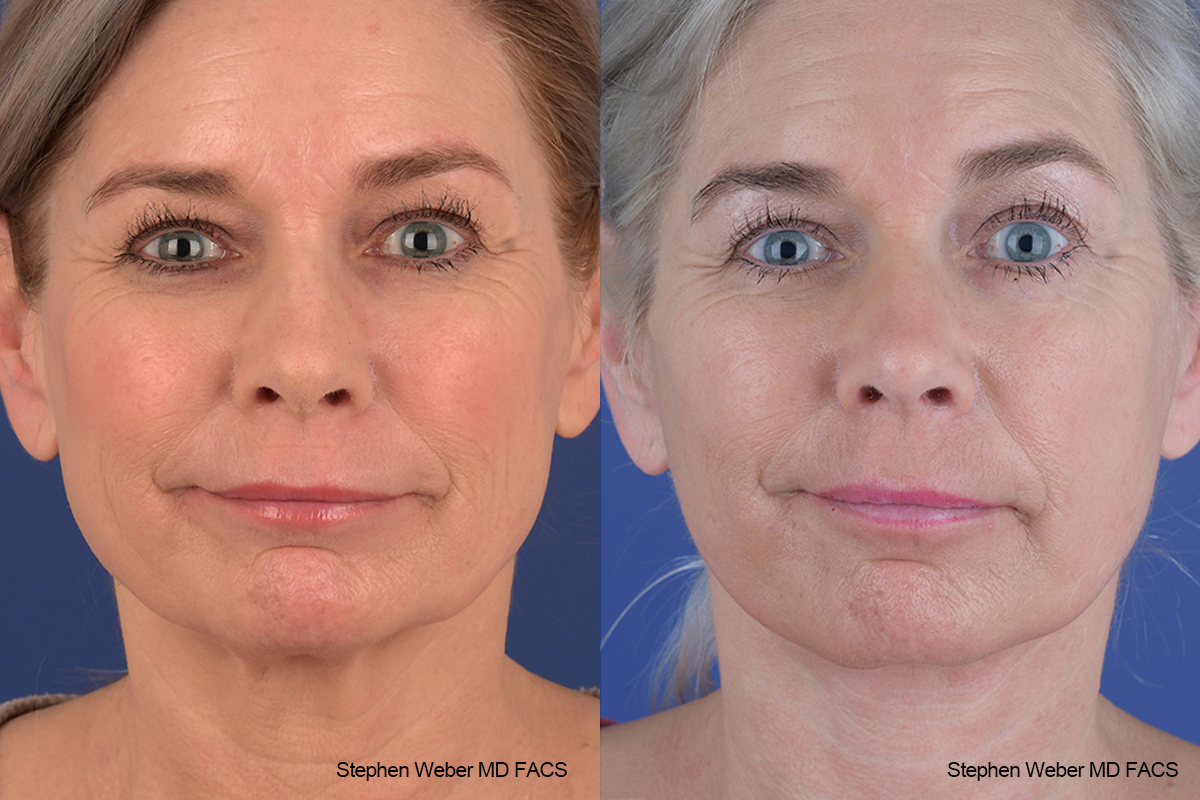Facelift Before and After | Weber Facial Plastic Surgery
