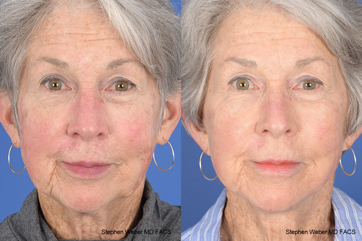 Facelift Before and After | Weber Facial Plastic Surgery