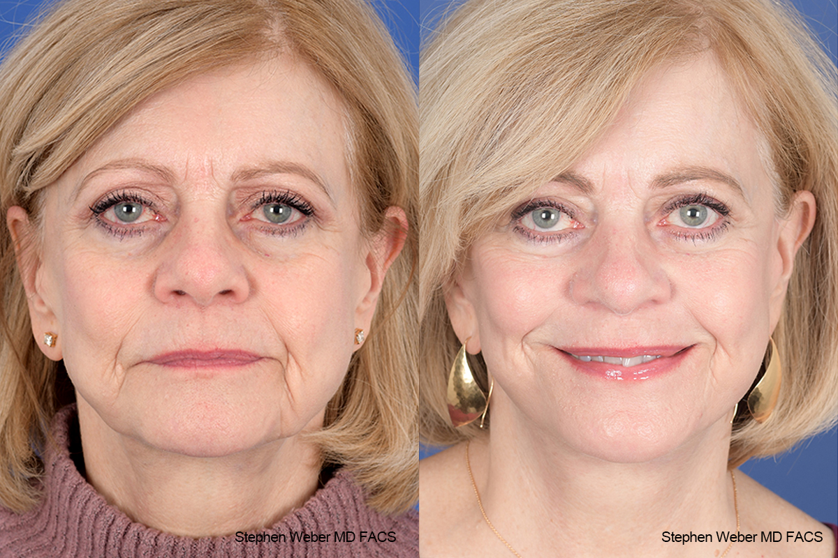 Facelift Before and After | Weber Facial Plastic Surgery